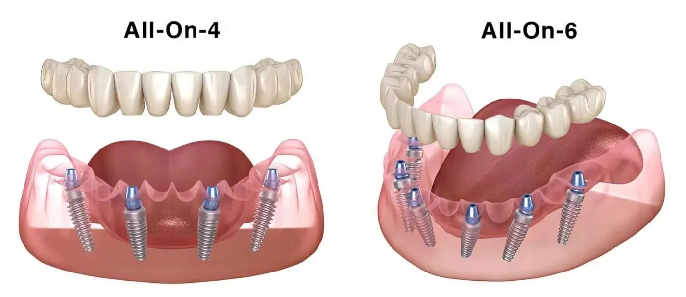 Comparison of All-on-4 and All-on-6 full-arch implant restorations