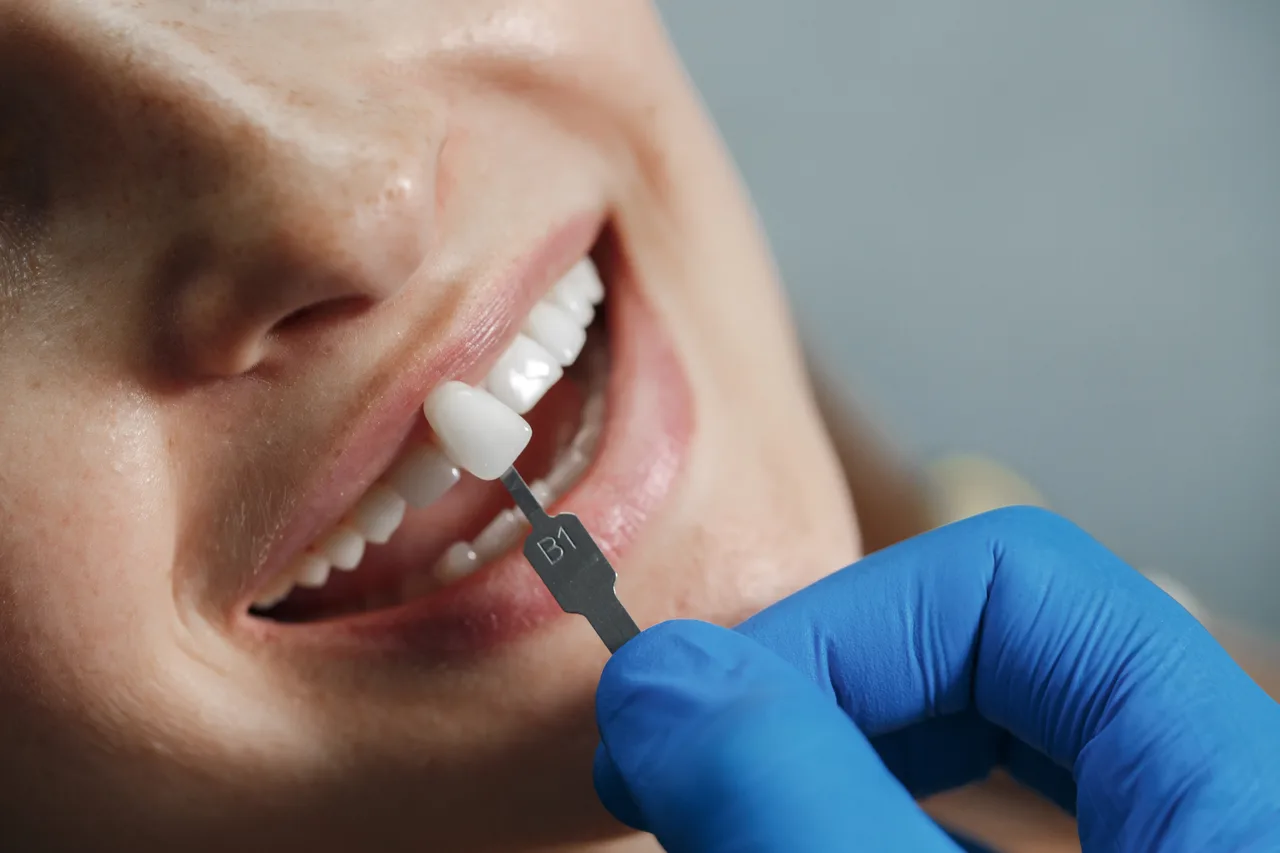 Dentist matching a porcelain veneer shade to a patient's tooth